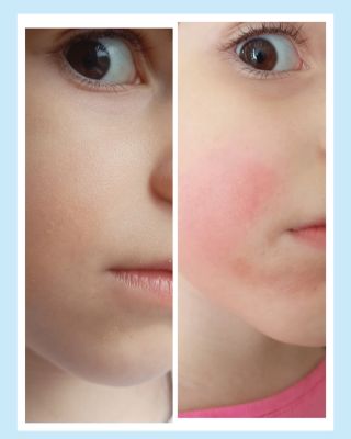 Vašich recenzí si moc vážíme, děkujeme 🩵 #phageglow #phagetherapy #beforeandafter #eczema #sensitiveskinfriendly